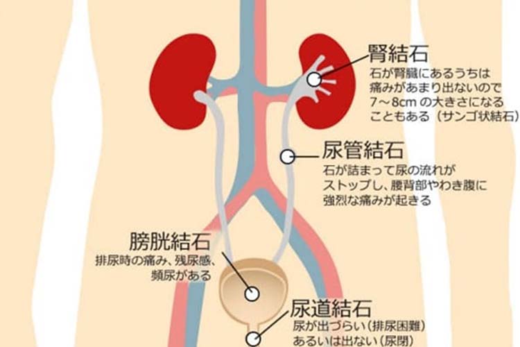 尿路結石について